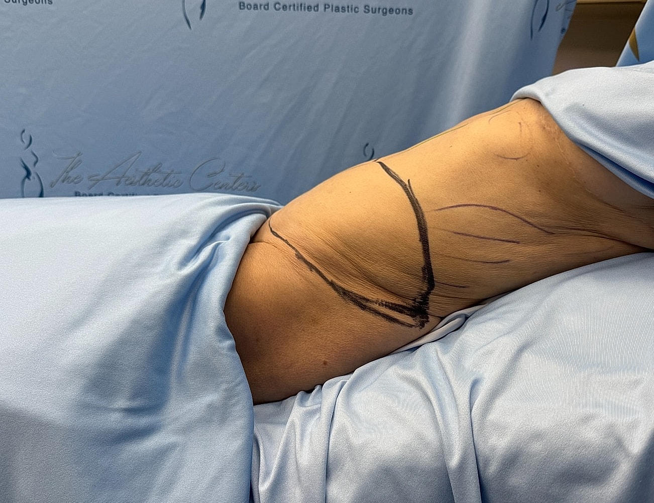 Marked arm prepared for plastic surgery consultation.
