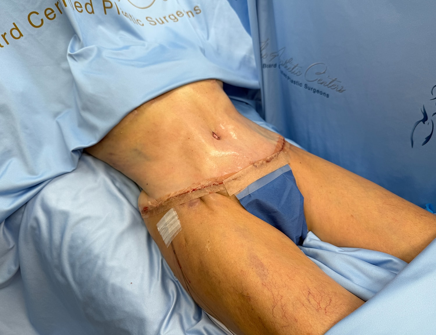 Patient post-surgery abdomen with sutures visible.