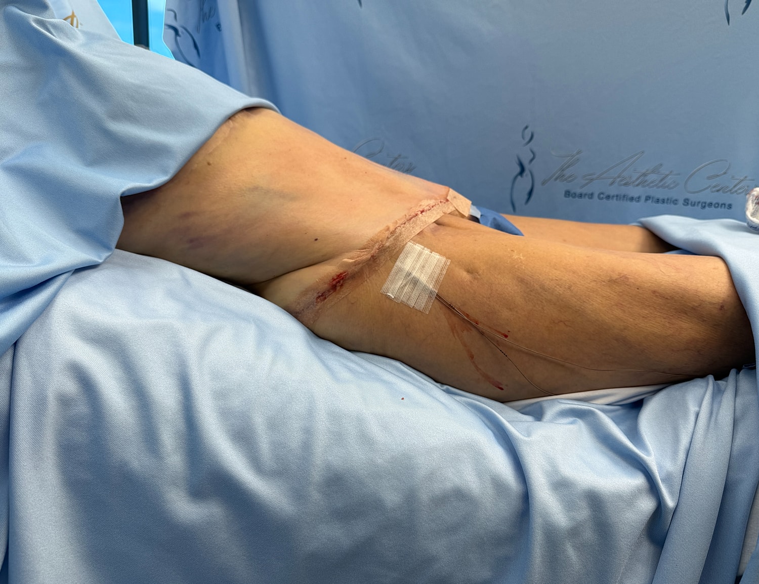 Surgical leg with bandage on blue fabric.