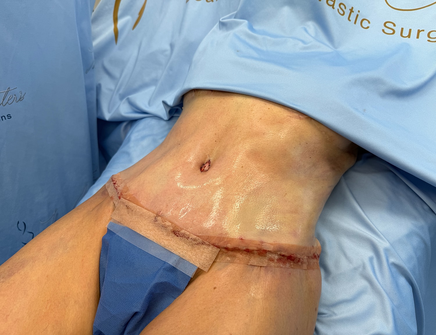 Post-surgery abdominal area with sutures visible.