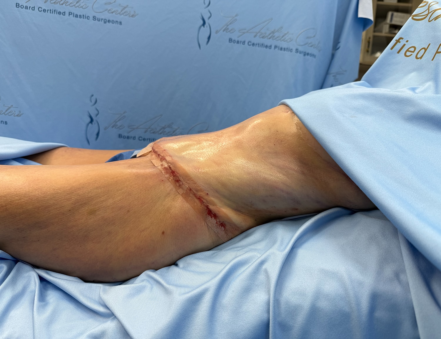 Surgical leg recovery with visible incision site.