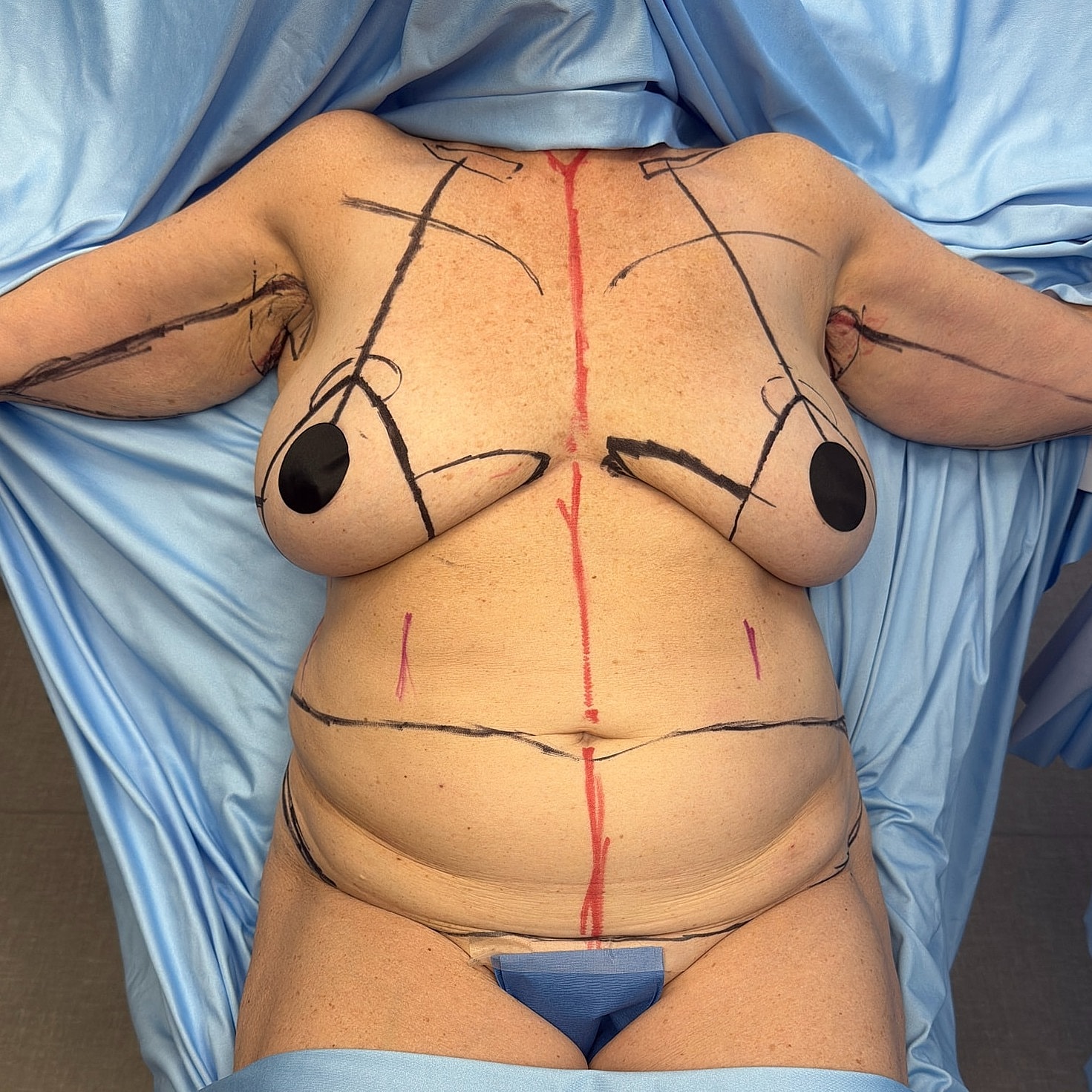 Body marked for cosmetic surgery procedure.