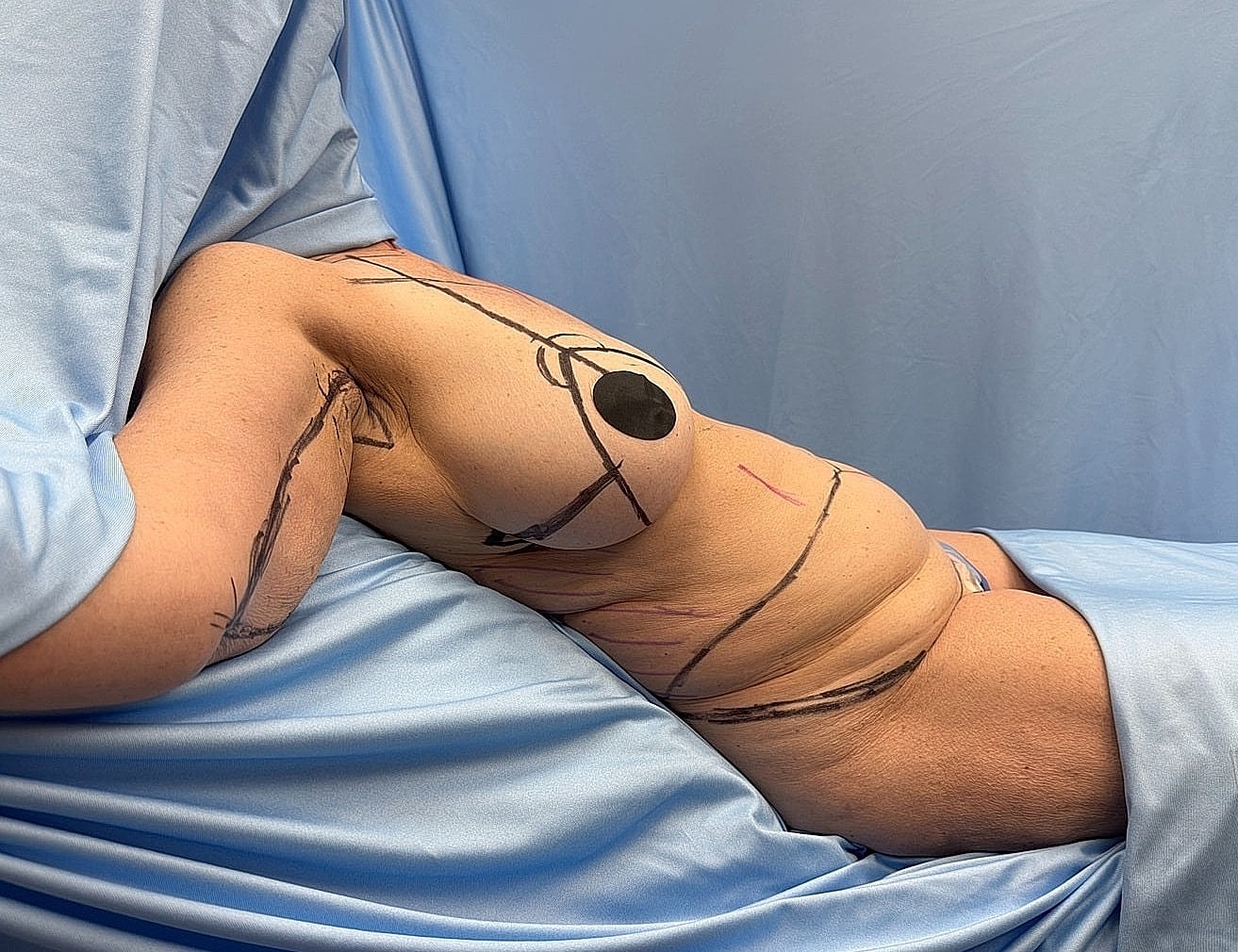 Body contours marked for surgical procedure.