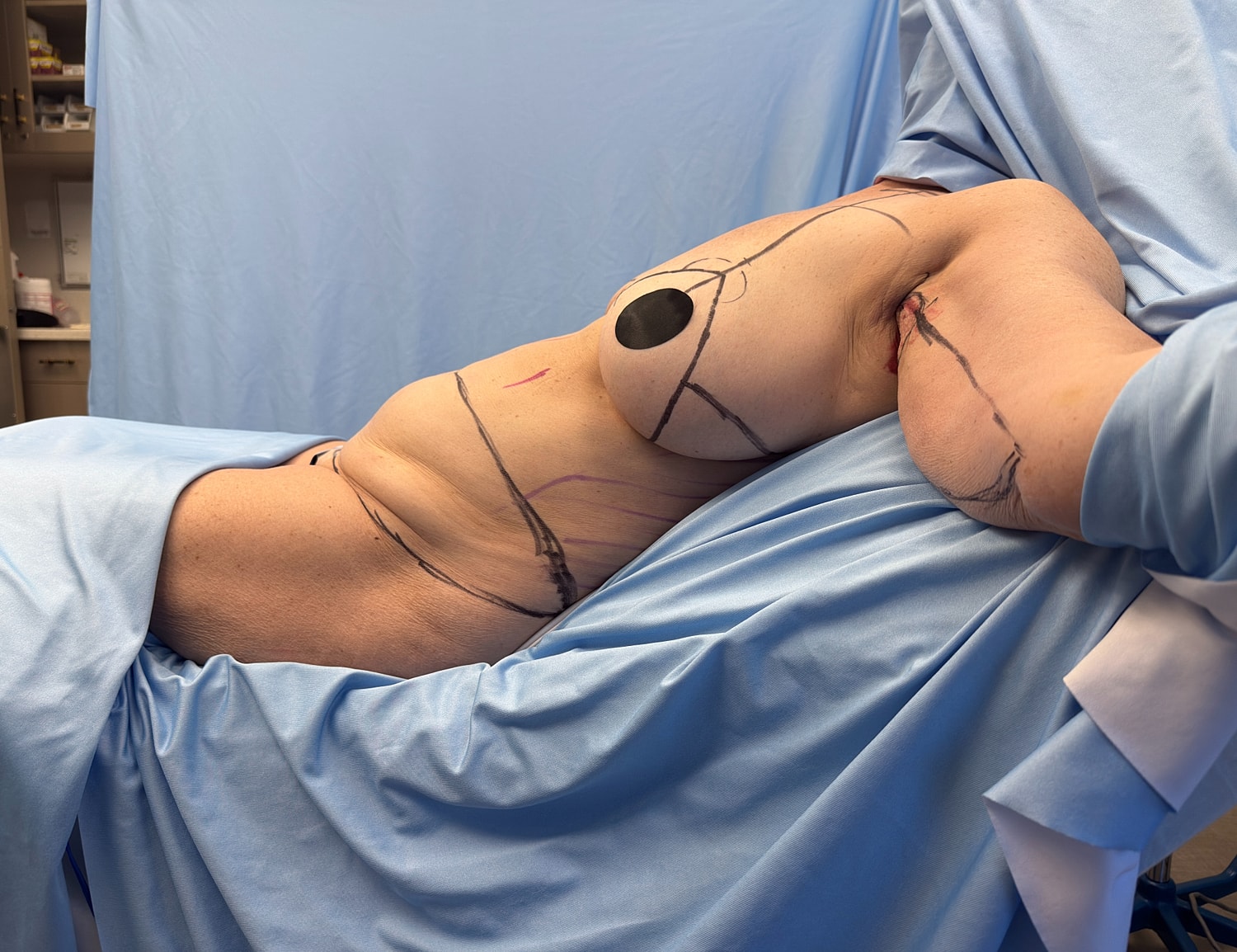 Surgical procedure on a patient in medical setting.