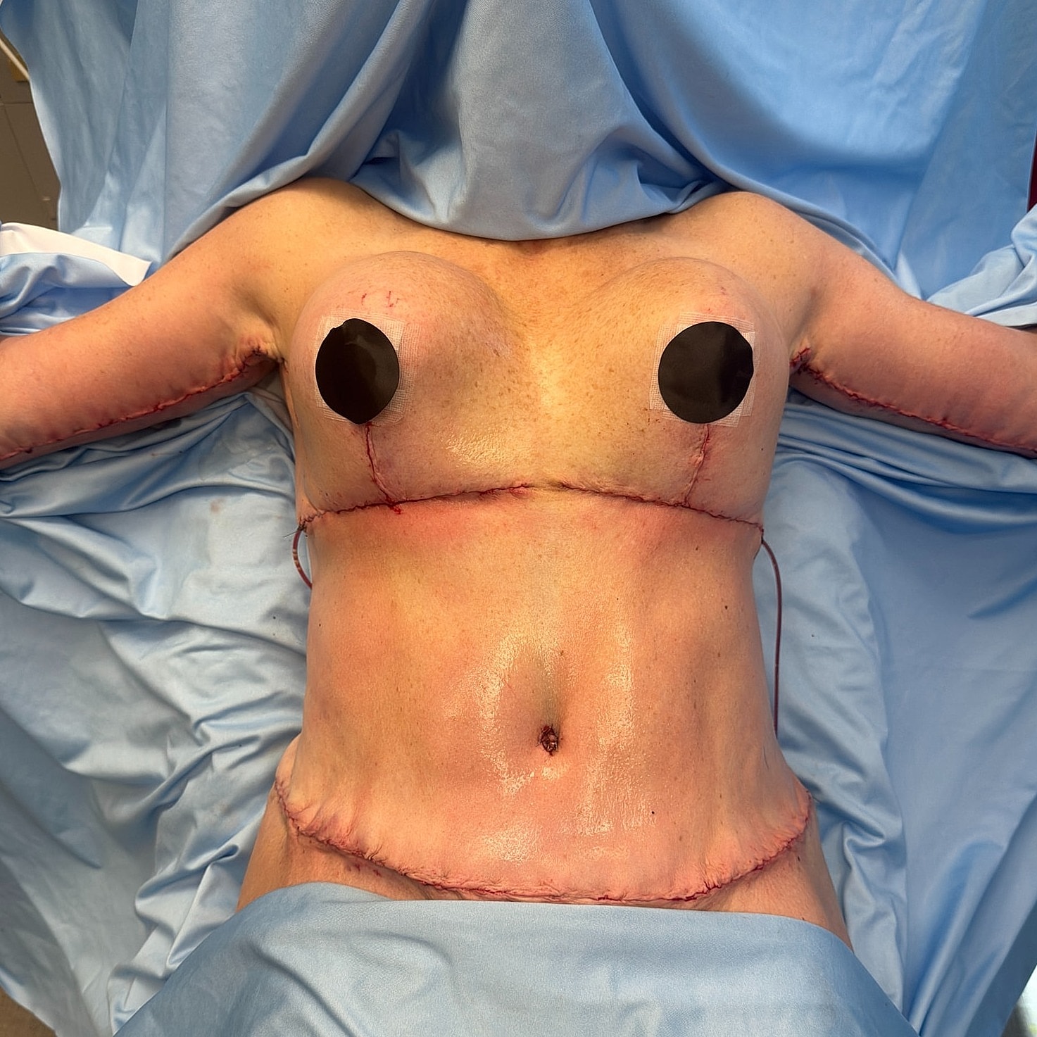 Surgical patient post-procedure, covered with drapes.