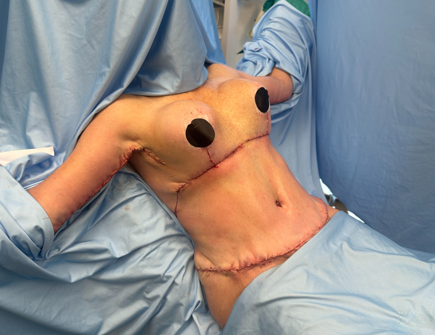 Post-surgery torso with visible stitches and markings.