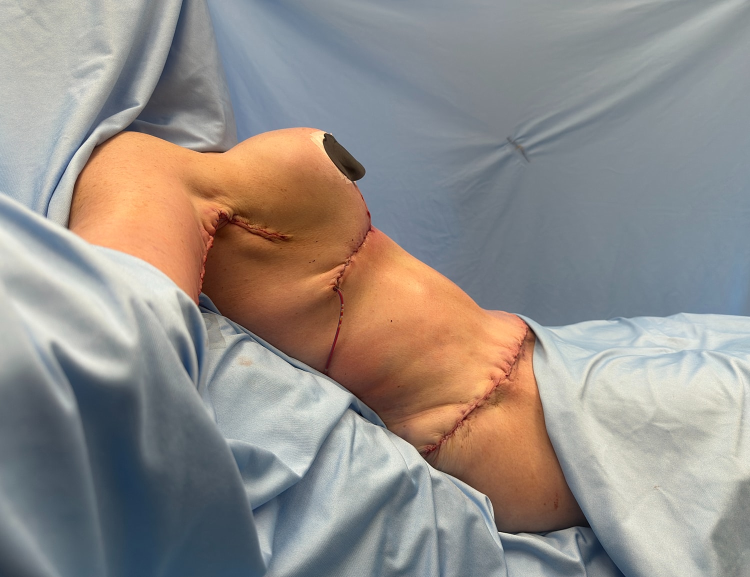 Post-surgery view of a torso with stitches.