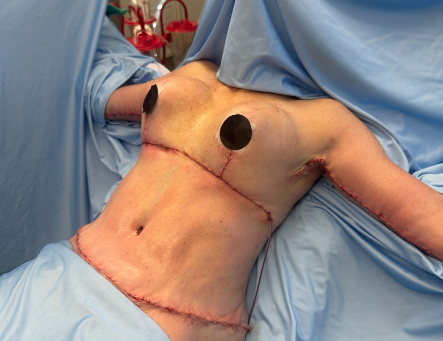 Post-surgery view of torso with stitches.