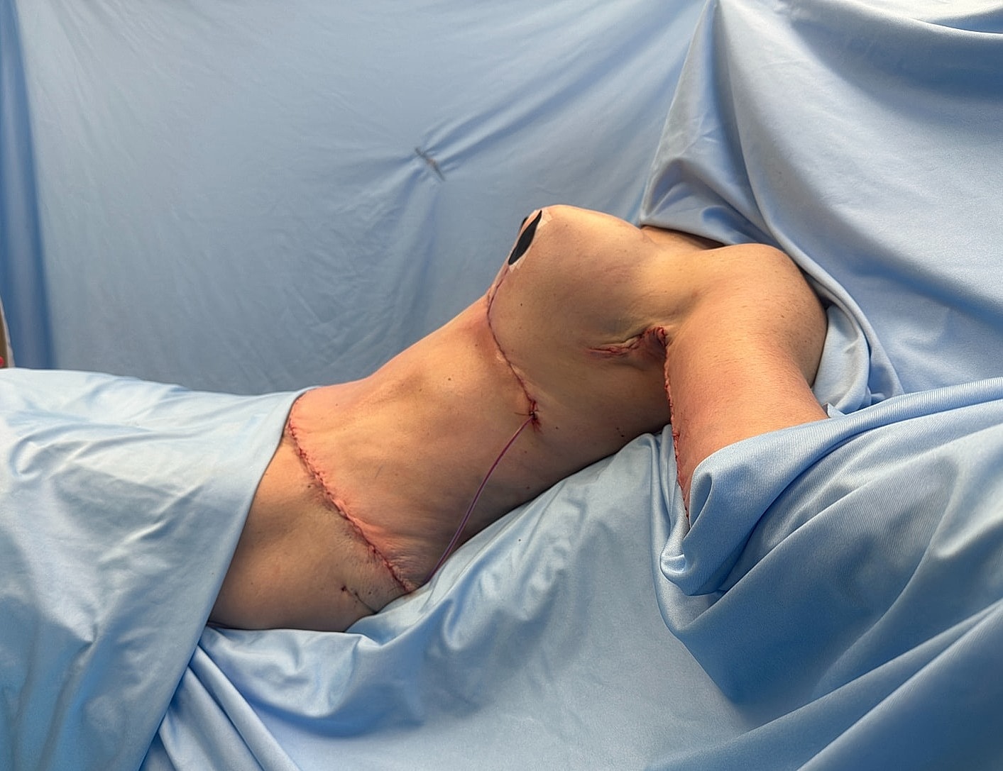 Surgical procedure on a patient's torso.