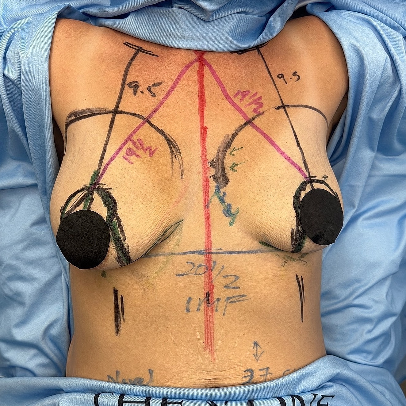 Body marked for plastic surgery procedure preparation.