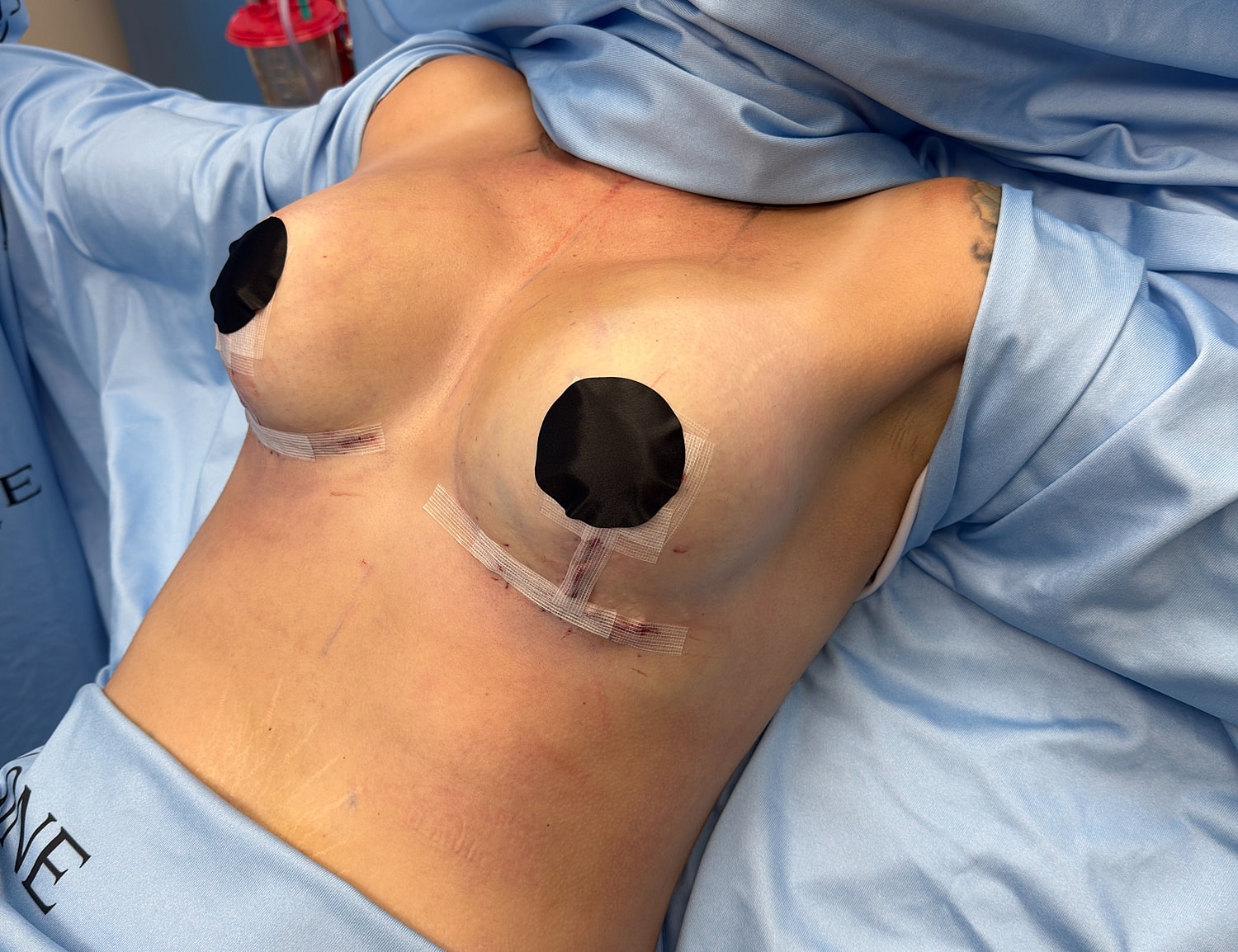 Post-surgery patient with dressings and blue drape.