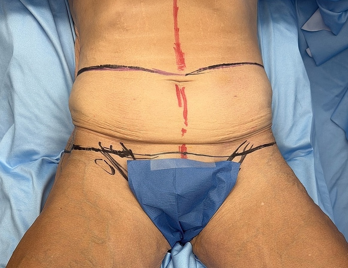 Surgical site markings on a patient's abdomen.