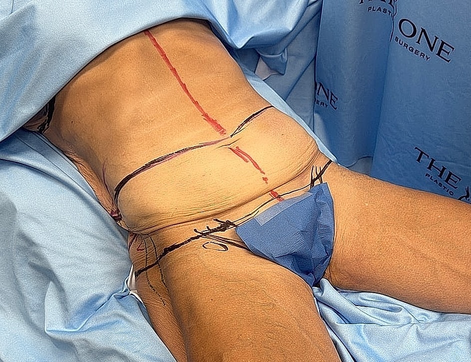 Patient preparation for plastic surgery procedure.