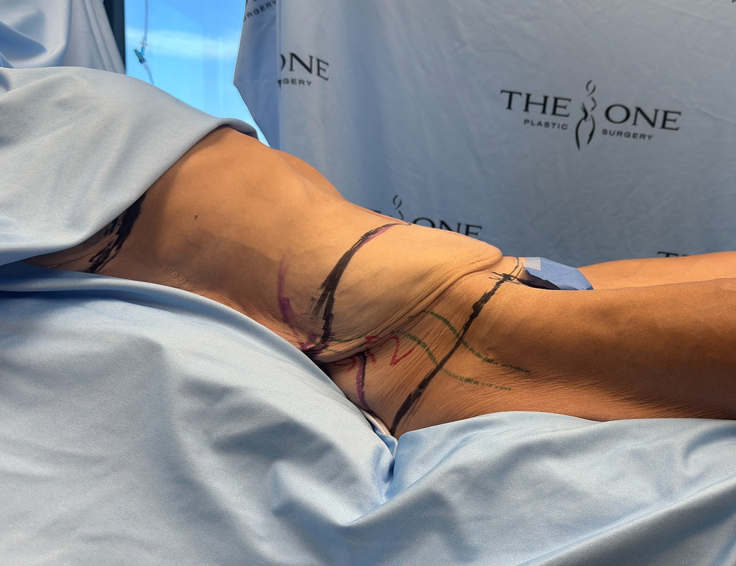 Body contouring markings before surgery procedure.