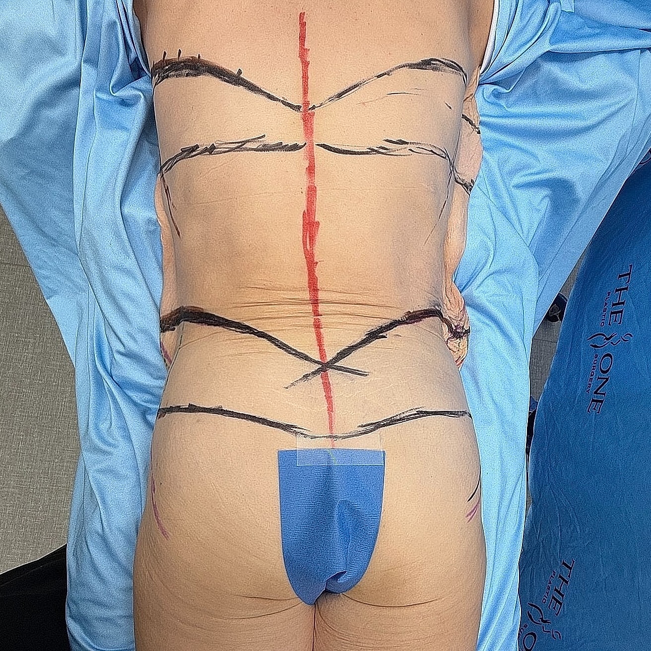 Body markings for surgical procedure on back.