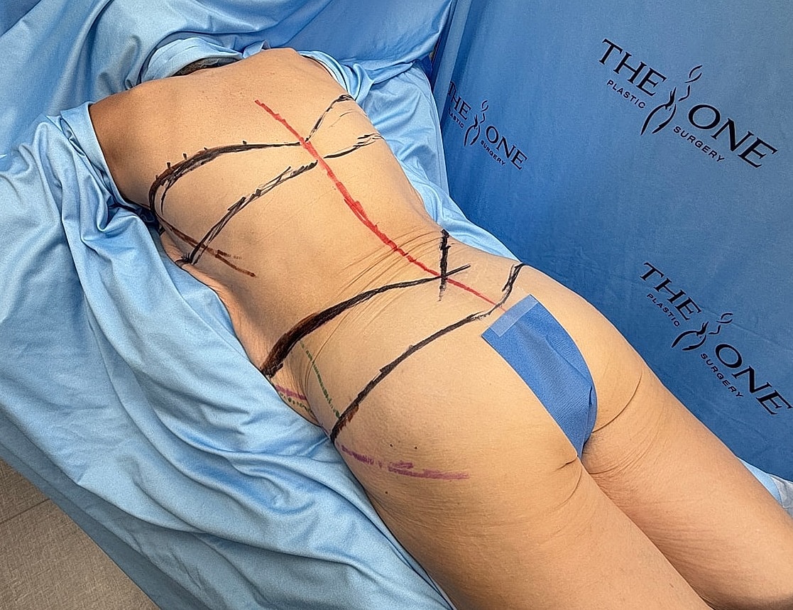 Patient preparing for plastic surgery procedure.