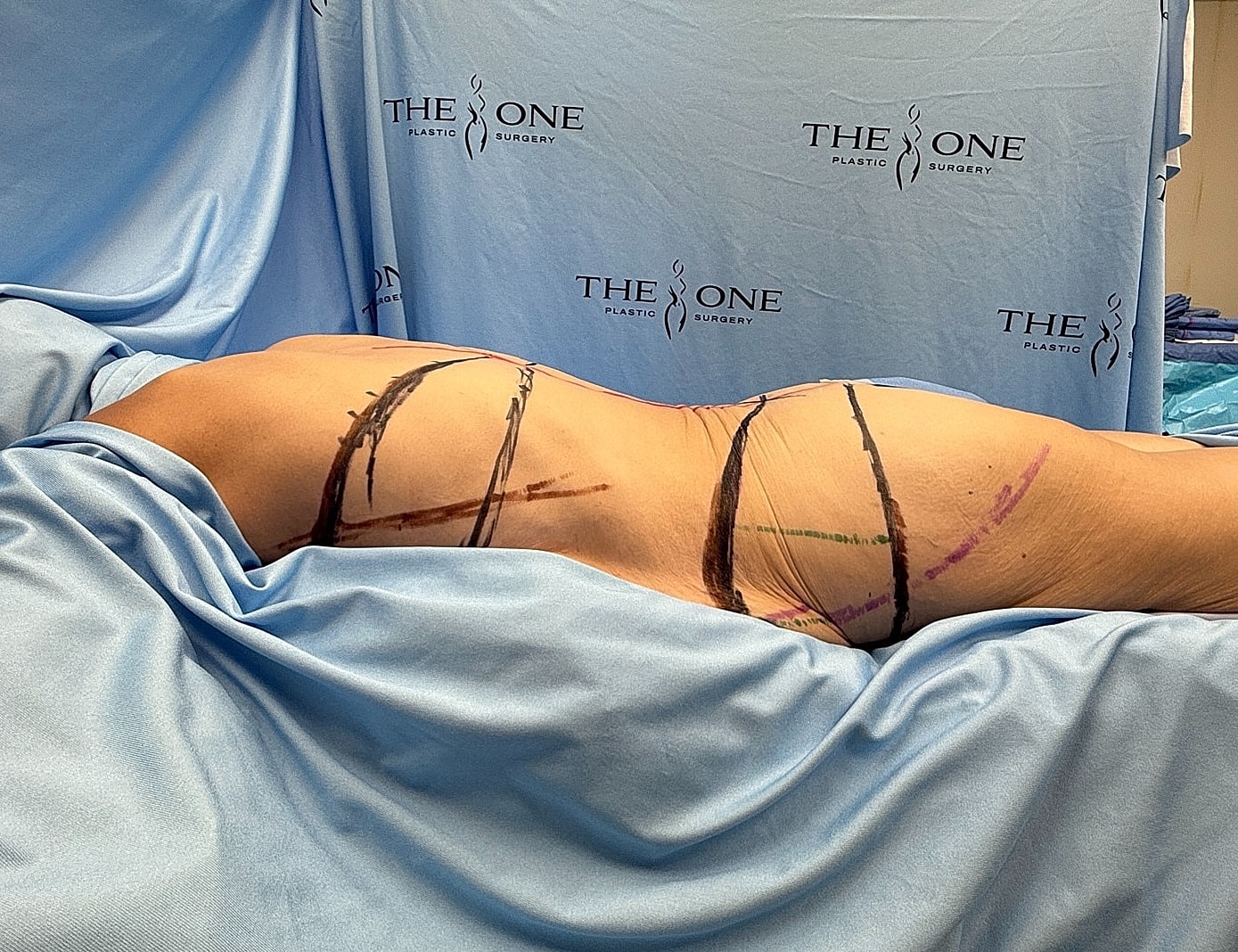 Body marking for plastic surgery procedure preparation.
