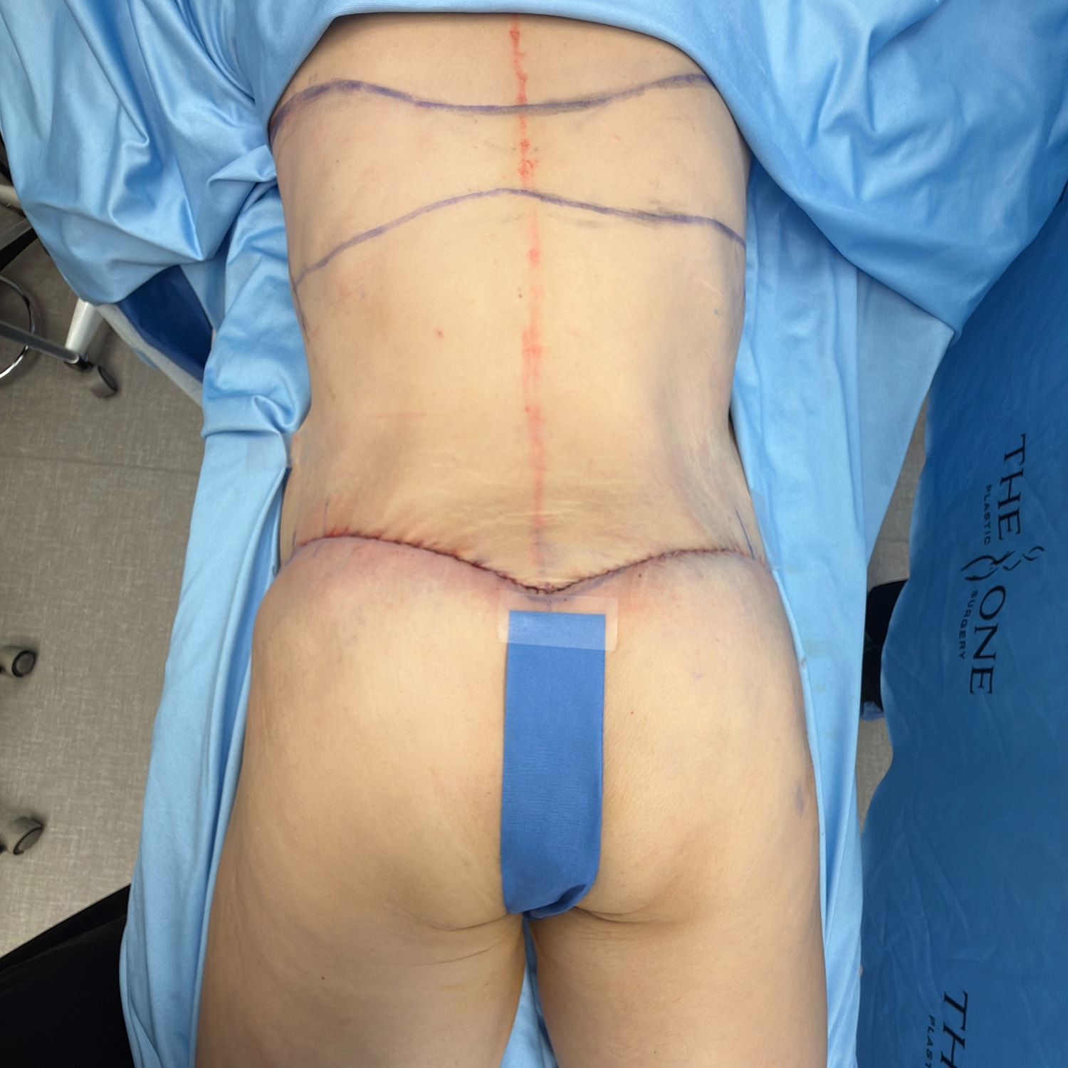 Surgical markings on a patient's lower back.