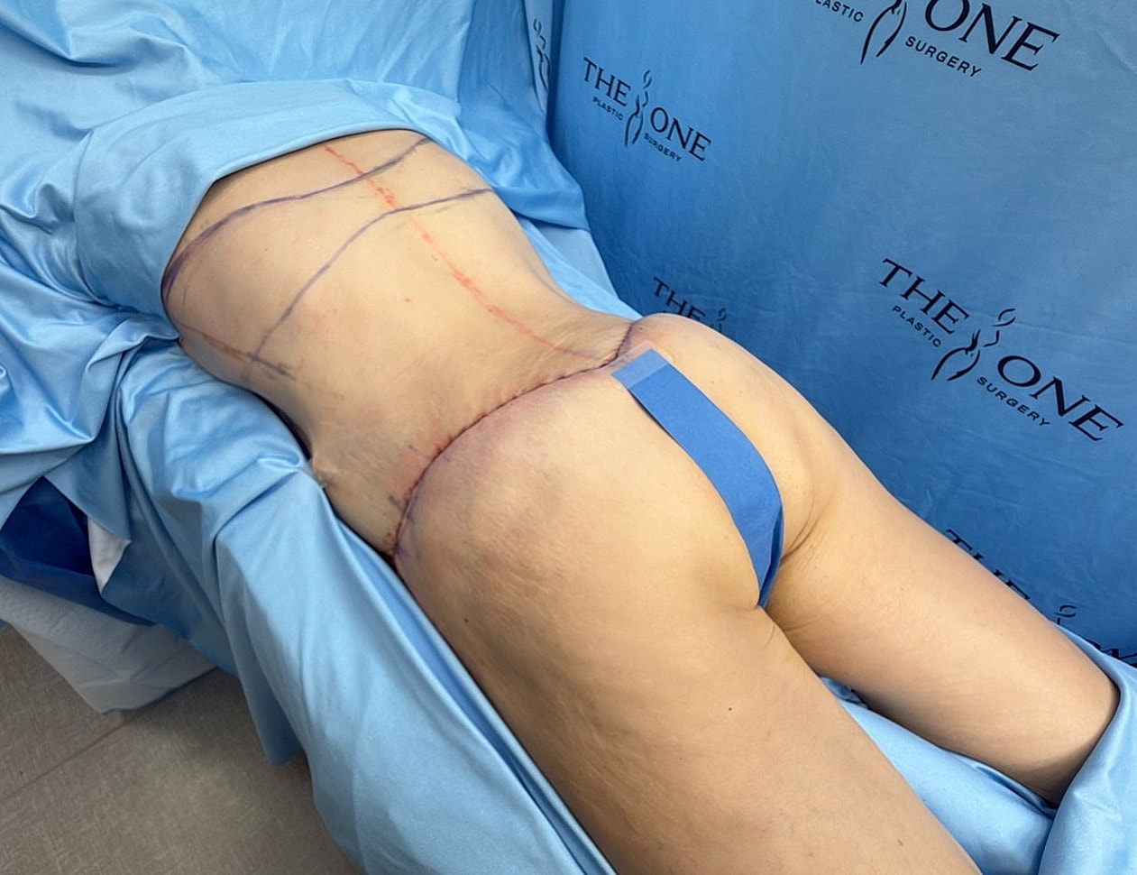Pre-surgery patient preparation in medical setting.