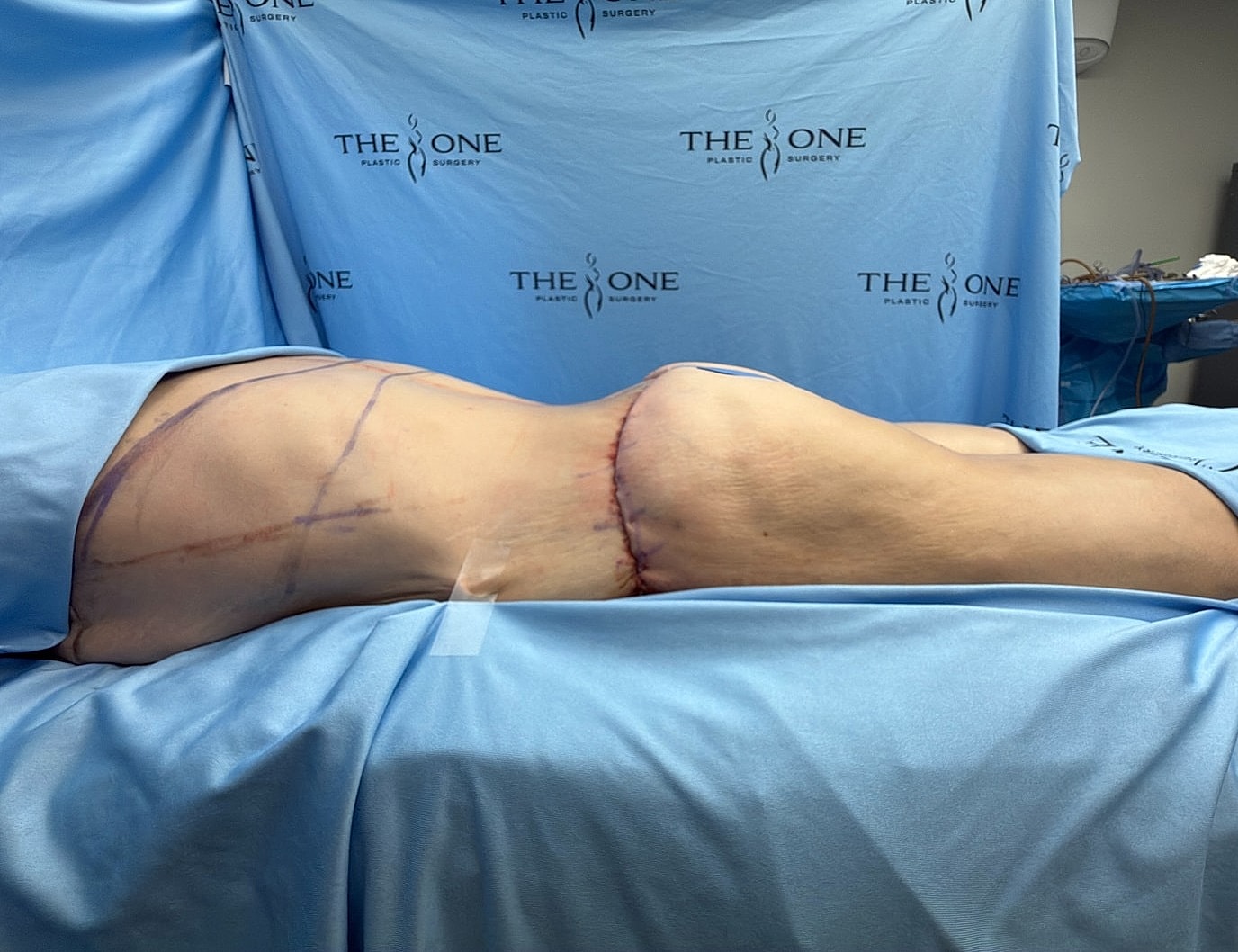 Surgical procedure on patient's hip area.