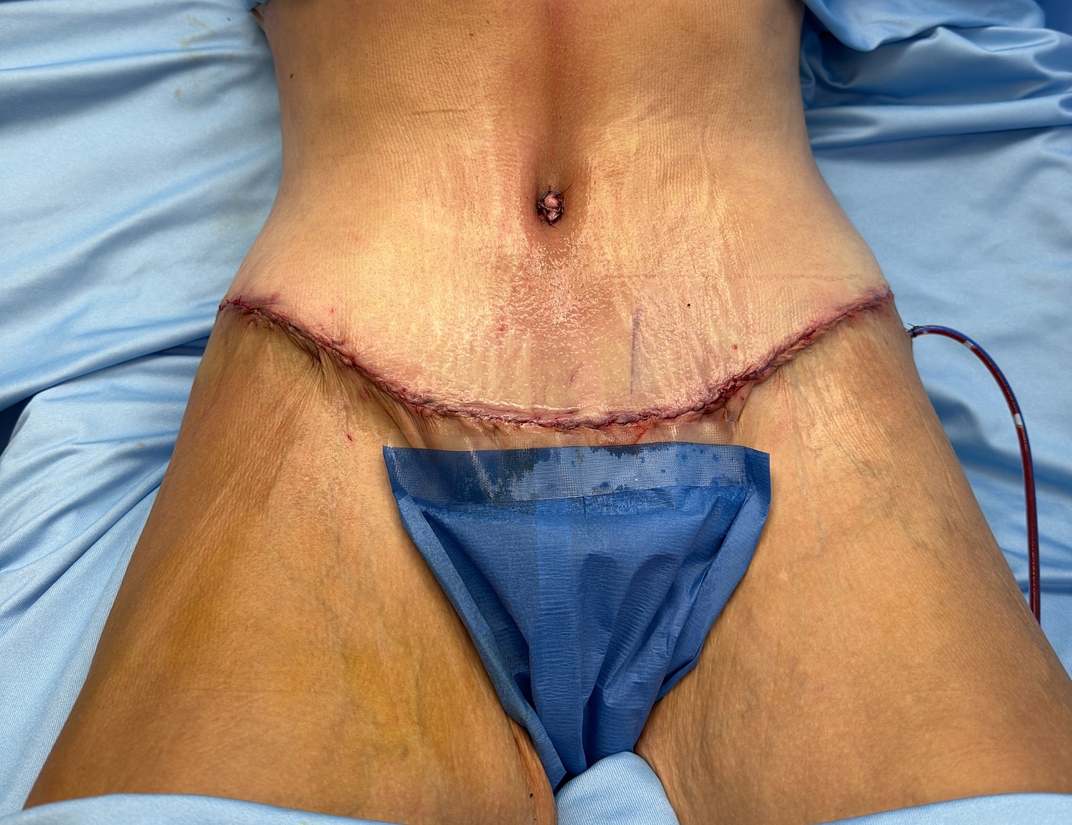 Surgical site with stitches and dressing applied.