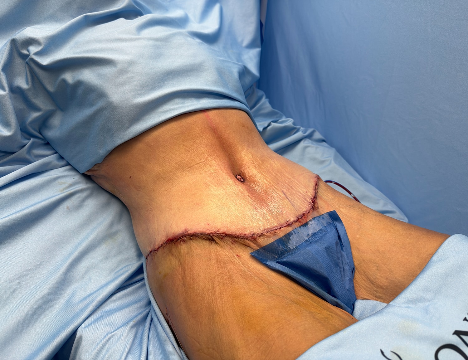 Surgical incision on a patient's abdomen.
