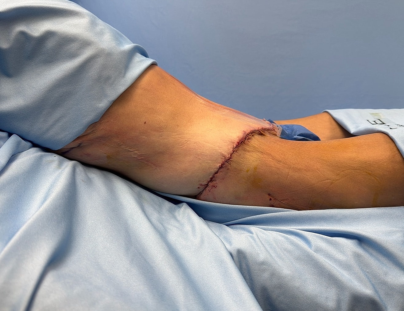 Surgical incision on patient's arm.
