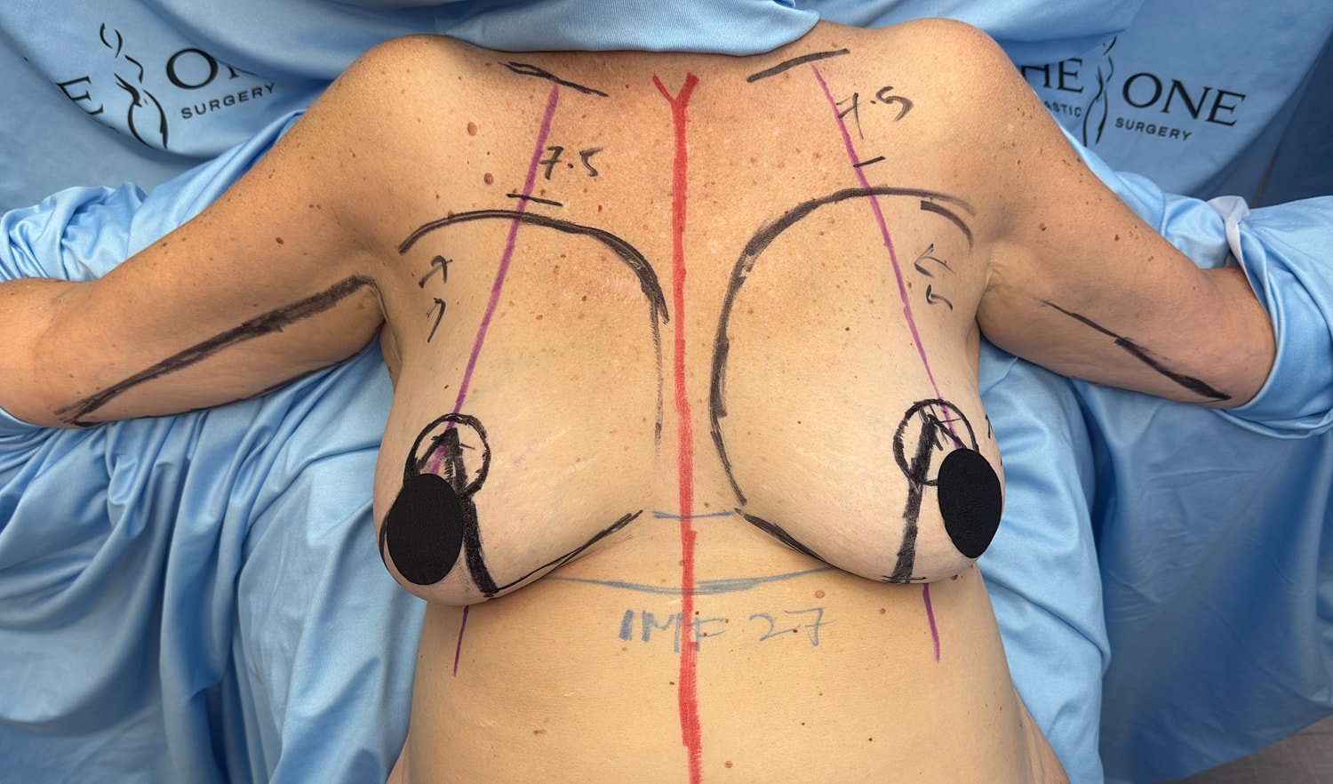 Pre-surgery markings on patient's back and chest.