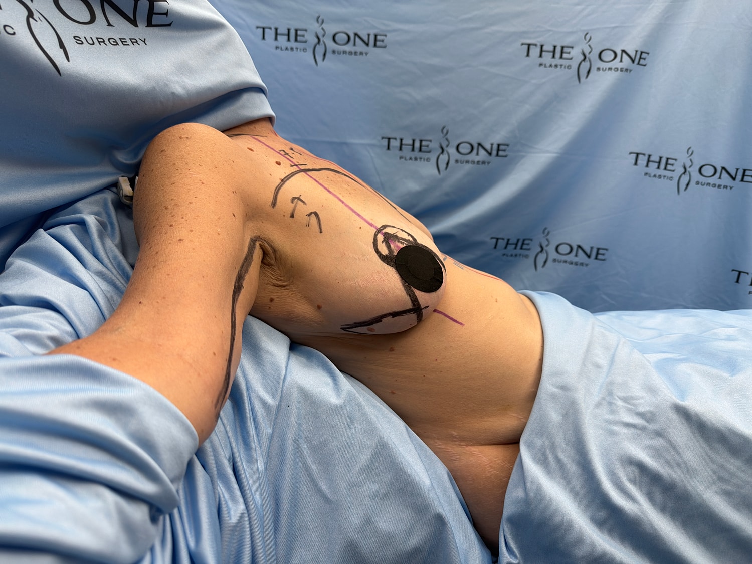 Pre-surgery markings on patient's torso.