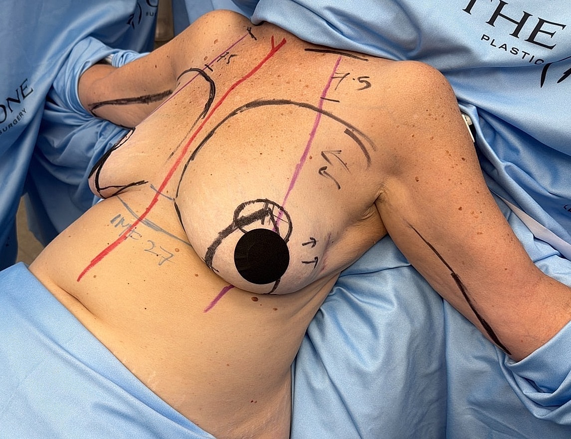 Surgical markings on torso prior to procedure.