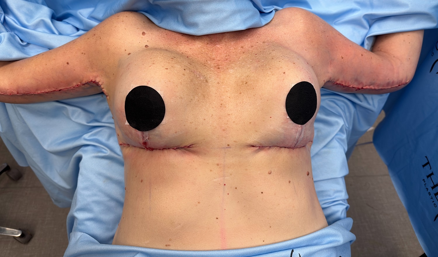 Post-operative visualization of chest surgery.
