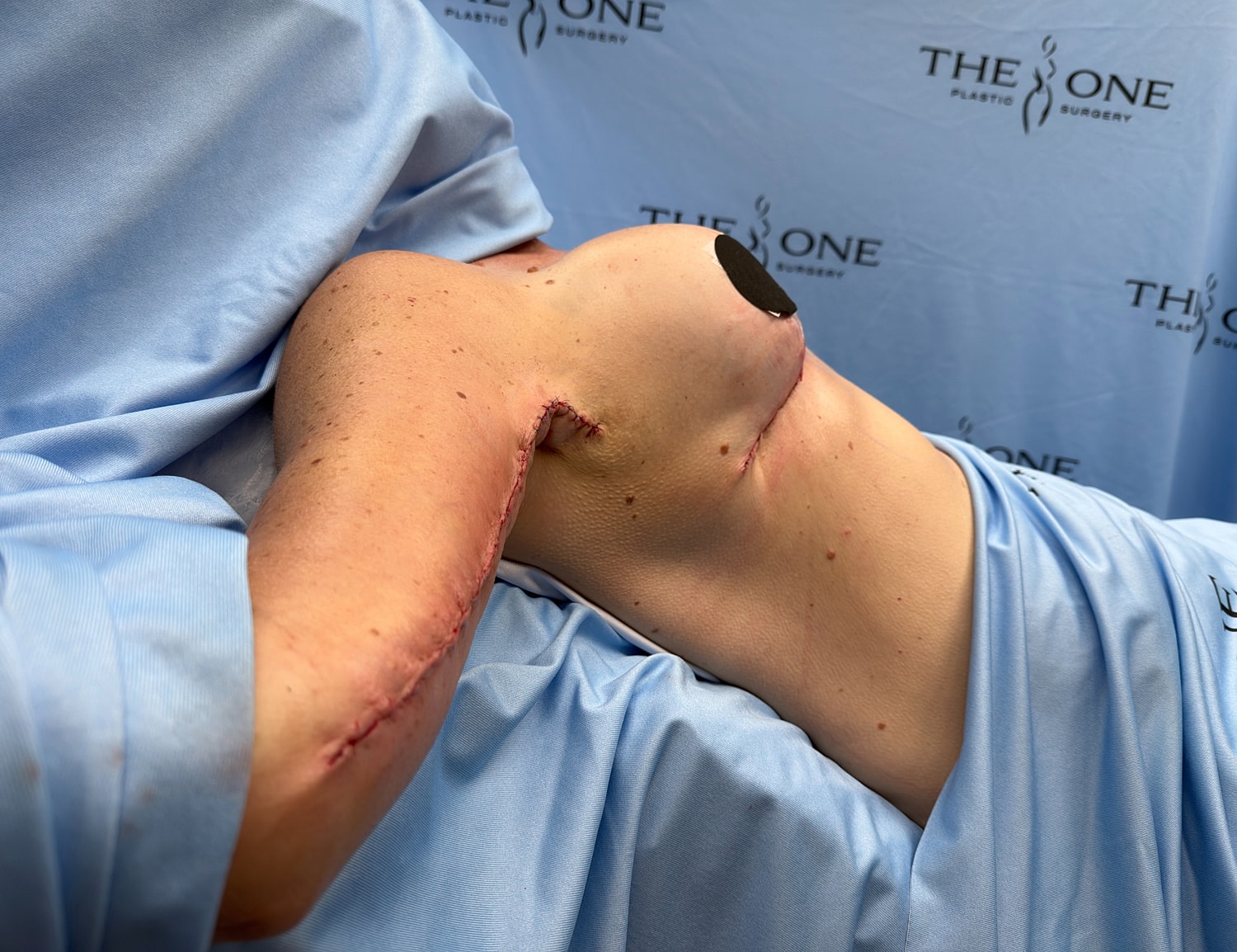Post-surgery breast reconstruction recovery image.