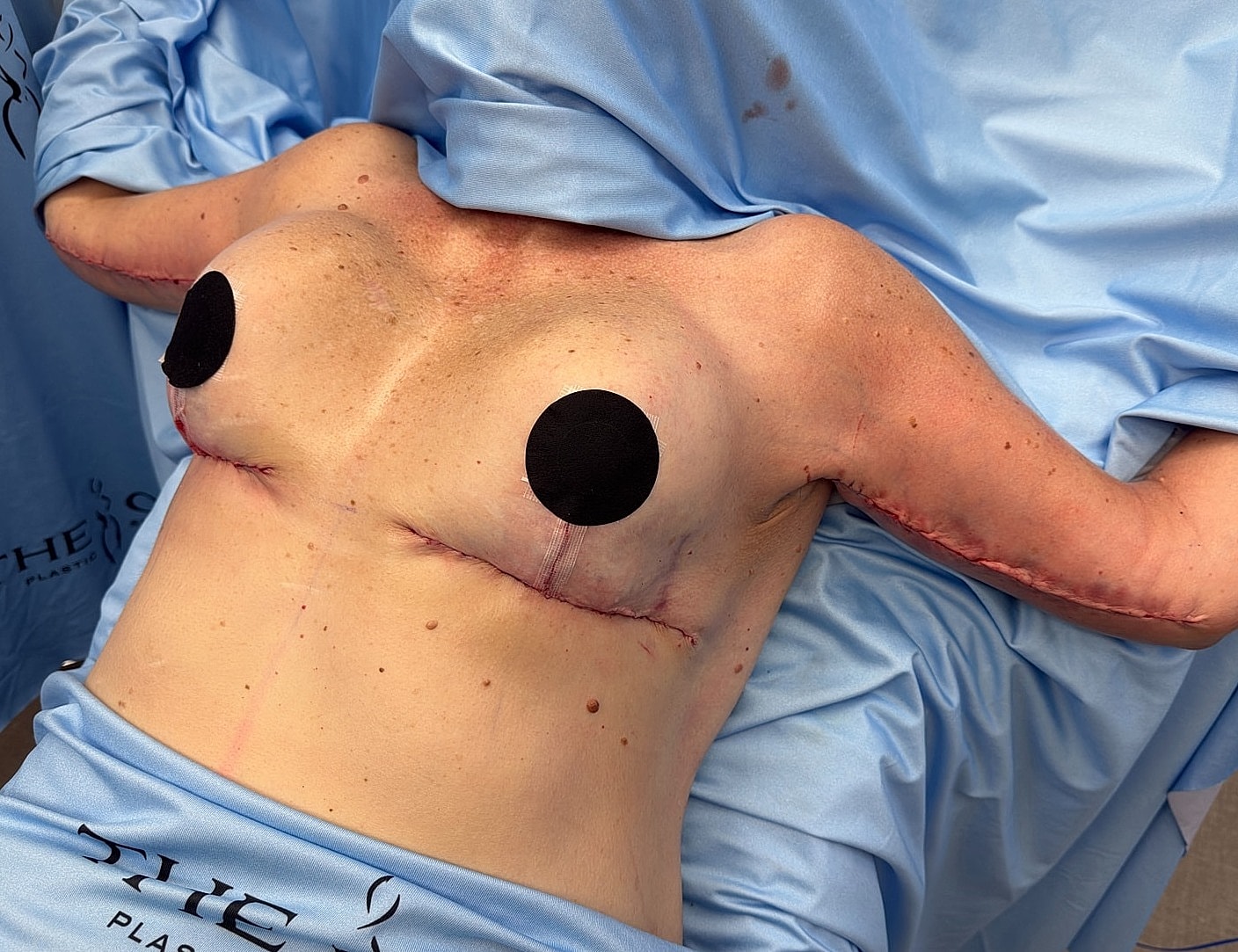 Post-surgery patient with surgical scars and dressings.