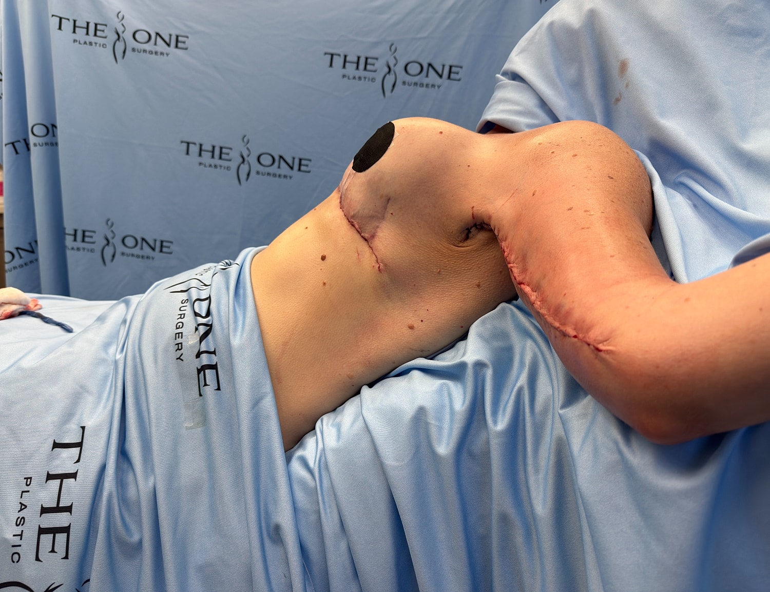 Post-surgery recovery showing stitched skin.