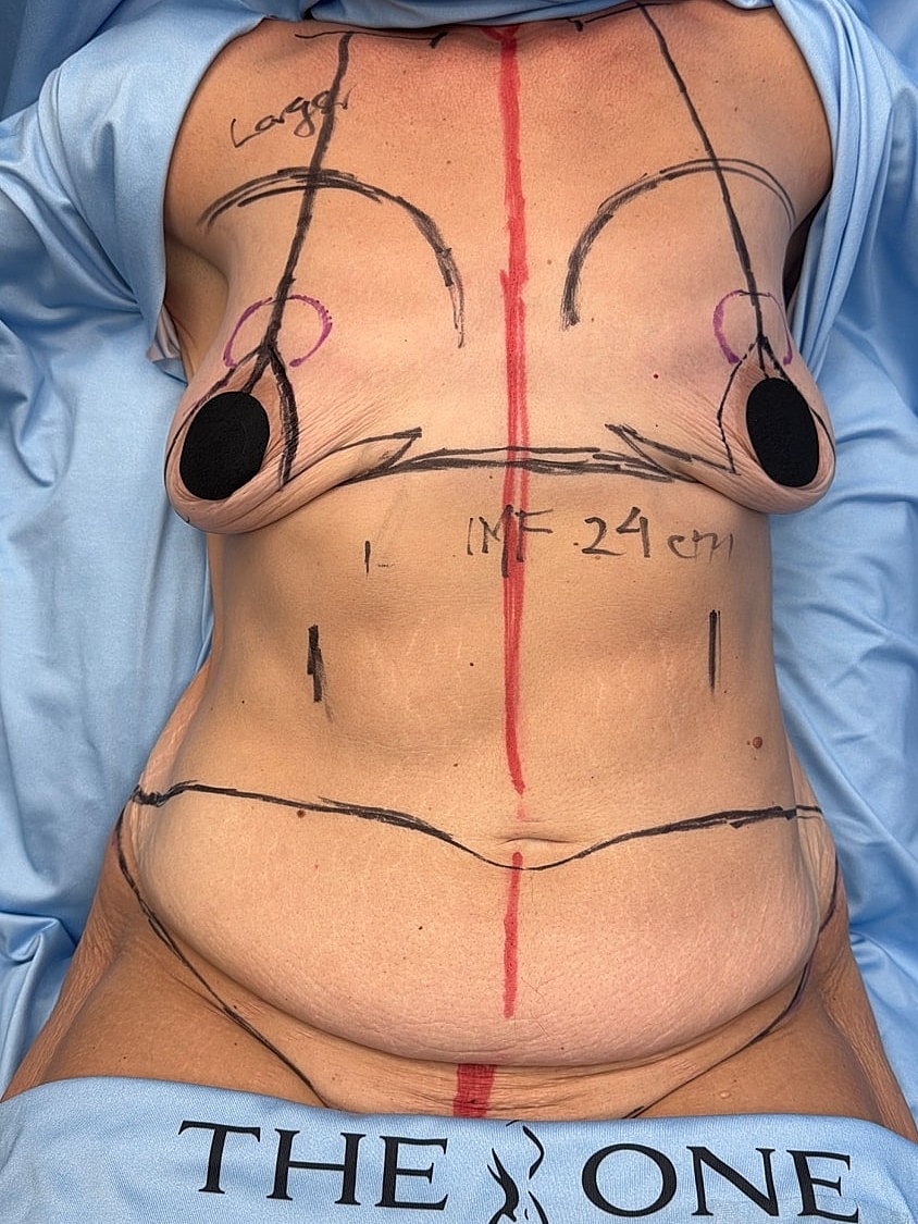 Breast surgery markings on a patient's torso.