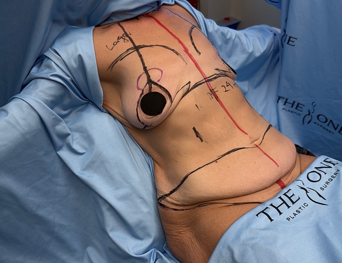 Surgical markings on abdomen before procedure.