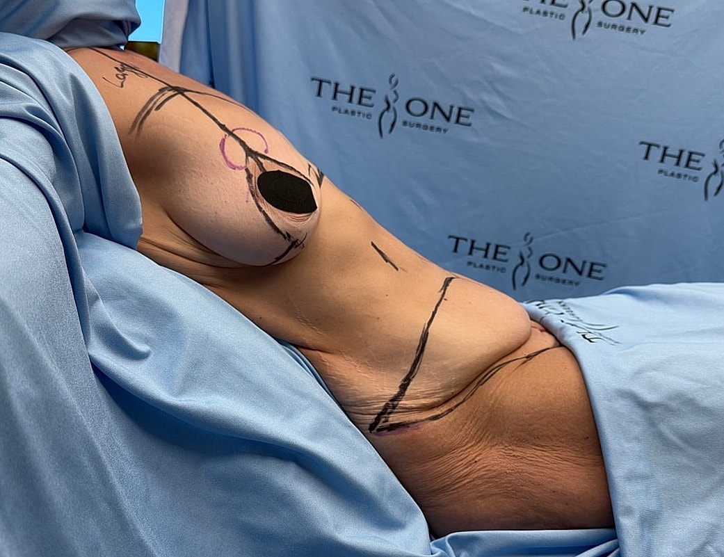 Surgical markings on torso for plastic surgery.