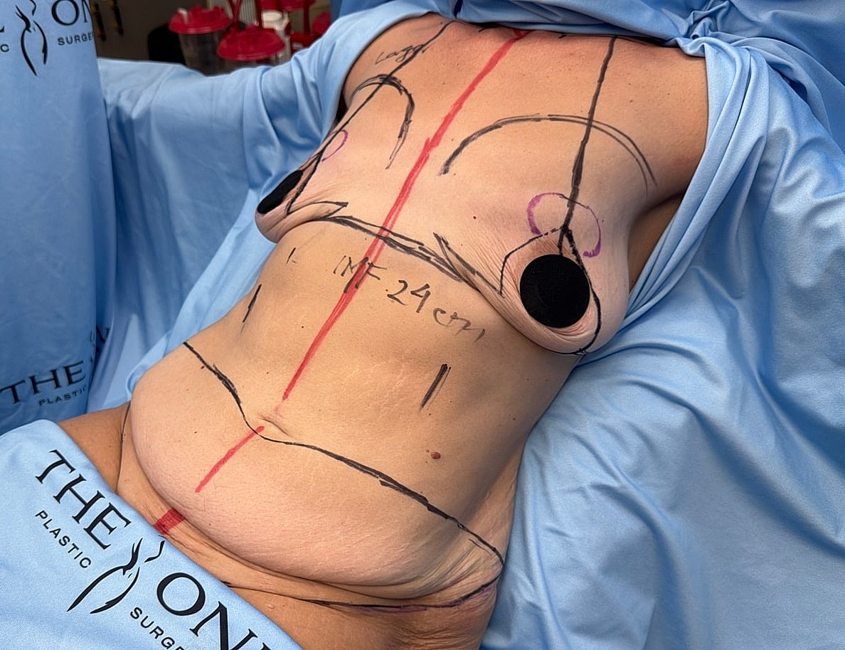 Surgical markings on torso before procedure.