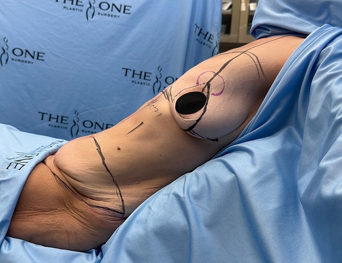 Surgical markings on a patient's torso.