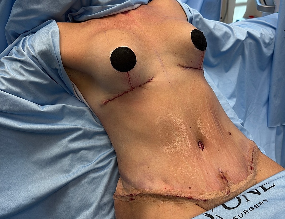 Post-surgery torso recovery with bandages.
