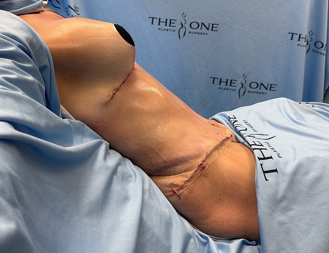 Post-surgery abdomen with sutures and bandages