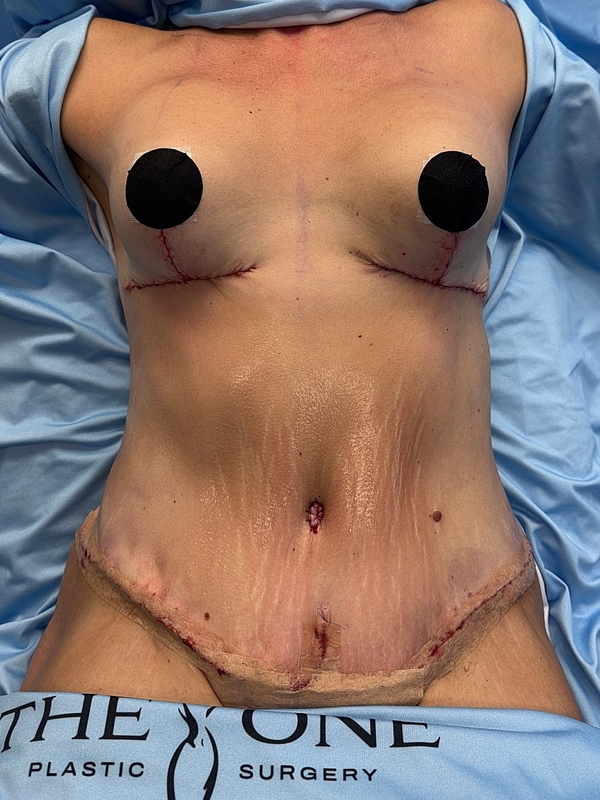 Post-surgery body with visible stitches and bandages.
