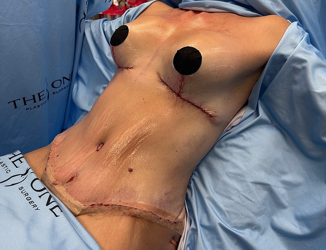 Surgical procedure on chest with incisions visible.