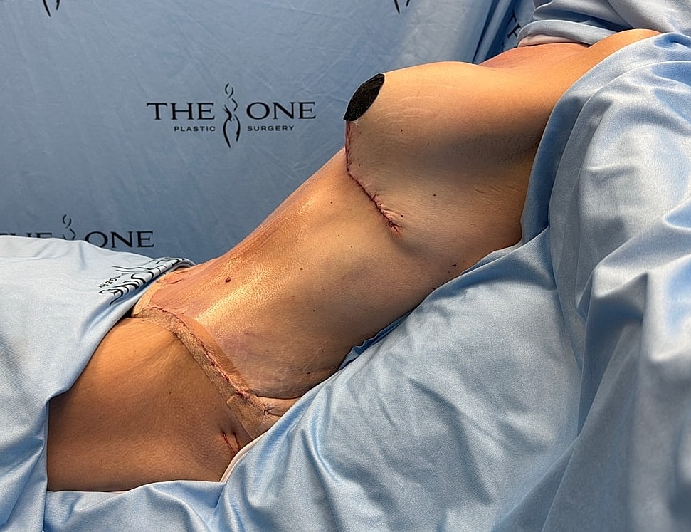 Post-surgery body with visible stitches and scars