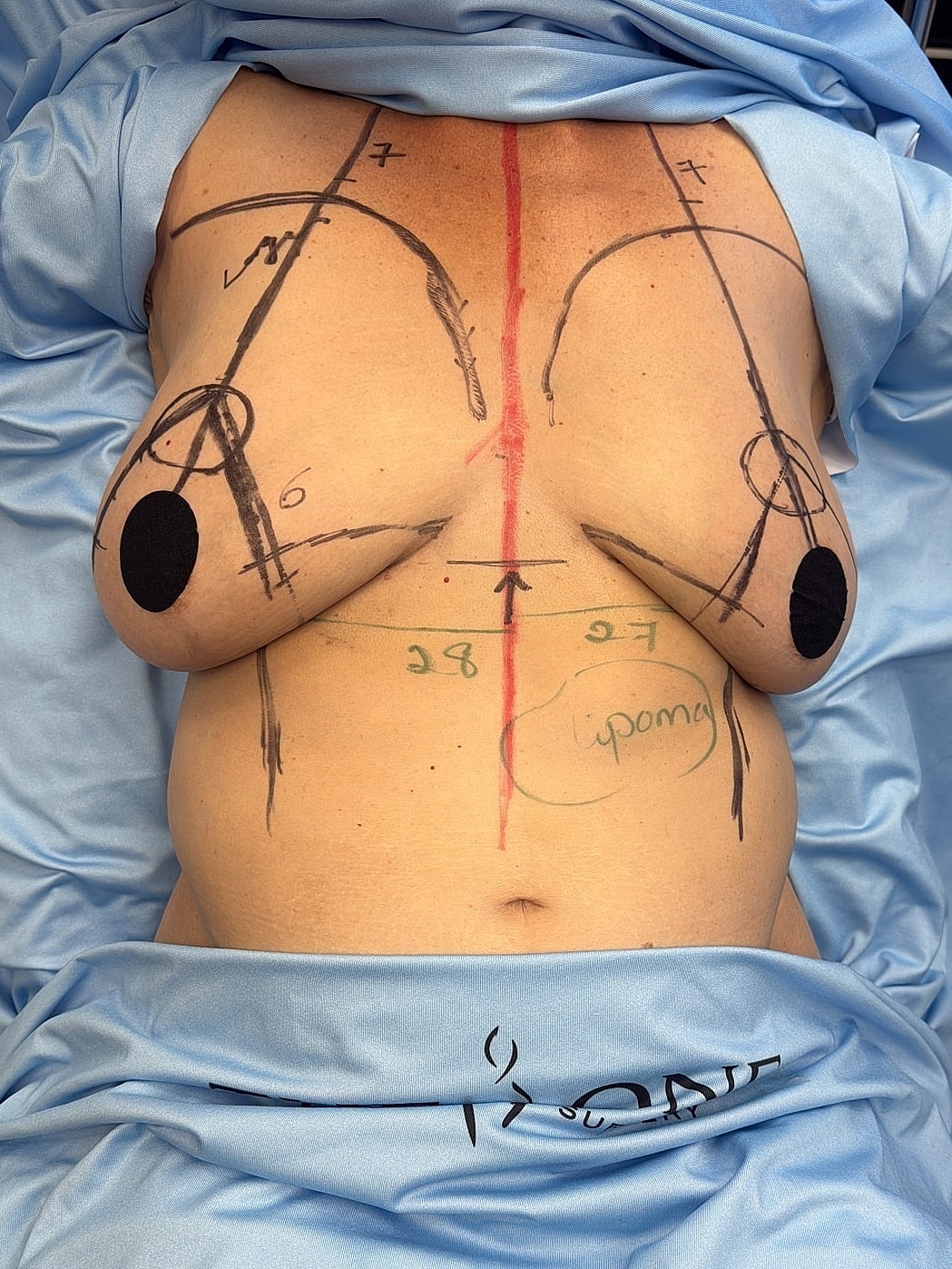 Surgical markings on a patient’s torso.