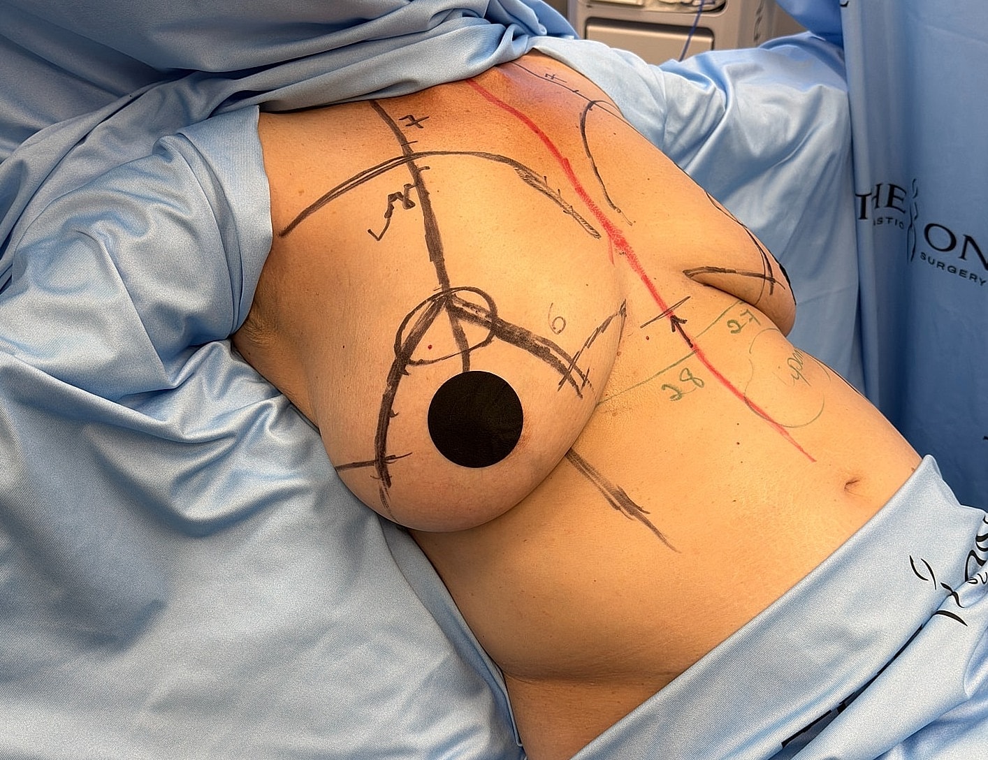 Surgical markings on torso before procedure