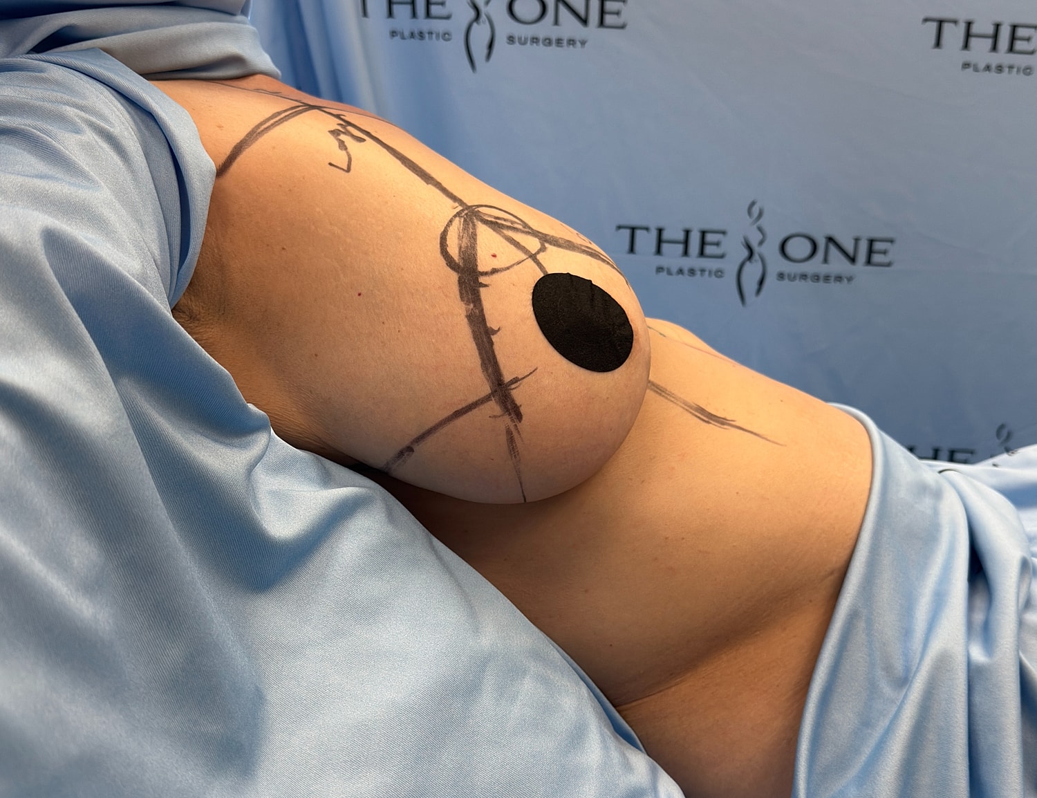 Pre-surgery markings on patient's body for procedure.