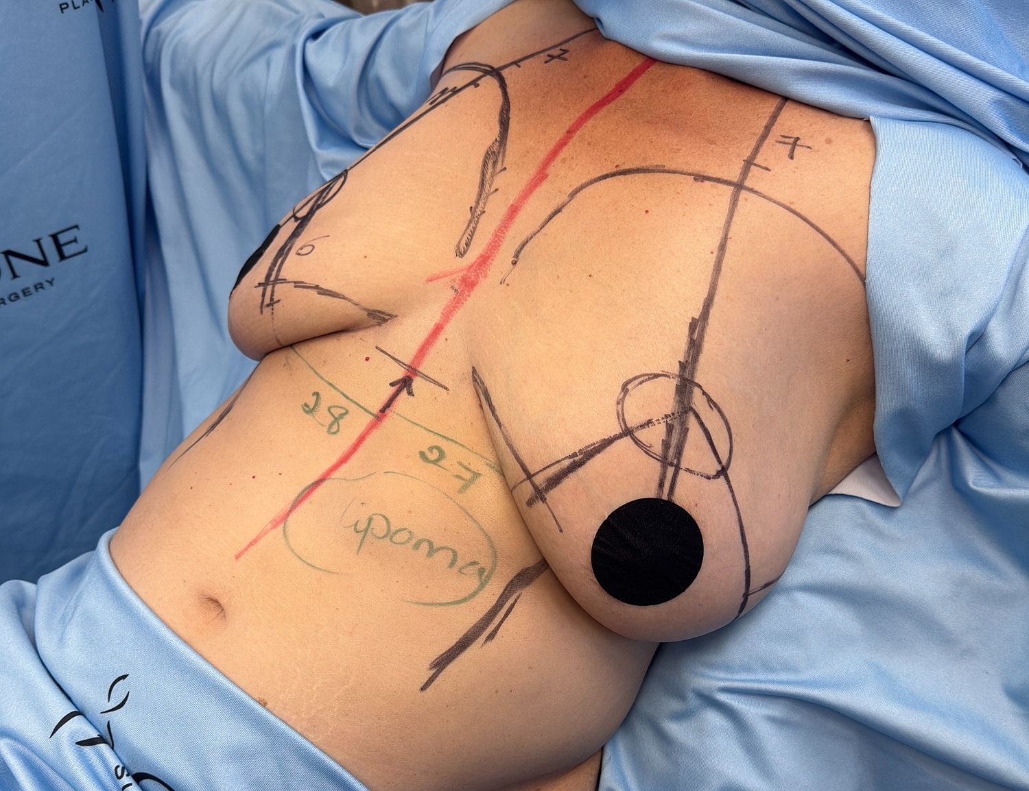 Surgical markings on abdomen prior to procedure.