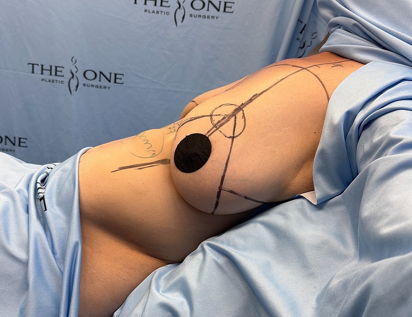 Patient preparation for cosmetic surgery procedure.