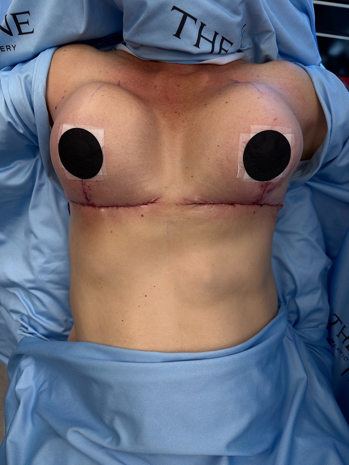 Post-surgery breast augmentation recovery stage image.
